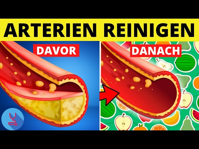 Diese Top 4 Lebensmittel reinigen deine Arterien und helfen bei der Vorbeugung von Arteriosklerose