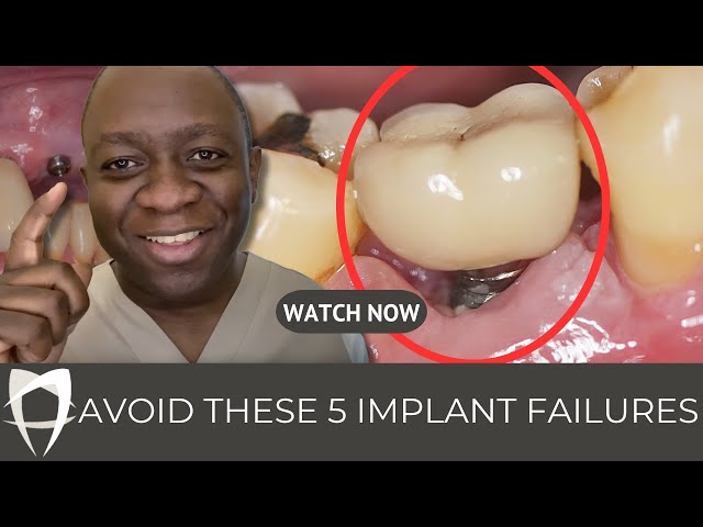 The Shocking TRUTH About Dental Implants in London: Pros & Cons EXPOSED! 😲 (2023)