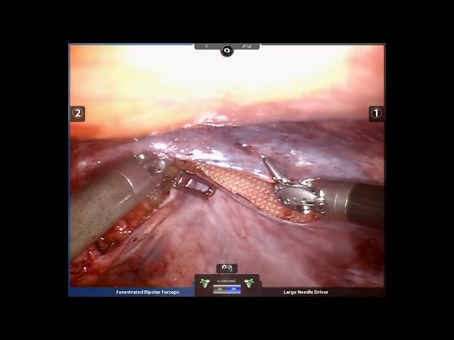 Robotic assisted repair of recurrent right inguinal hernia with mesh