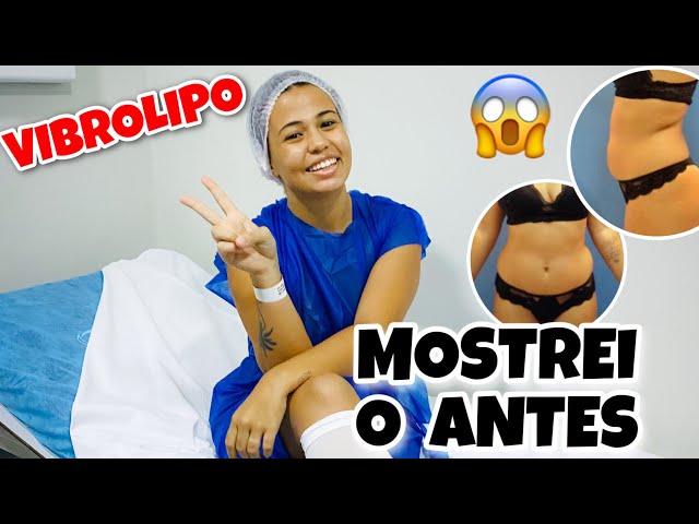 FIZ UMA VIBROLIPO - MOSTREI O ANTES DO MEU CORPO | Gabi Magsan