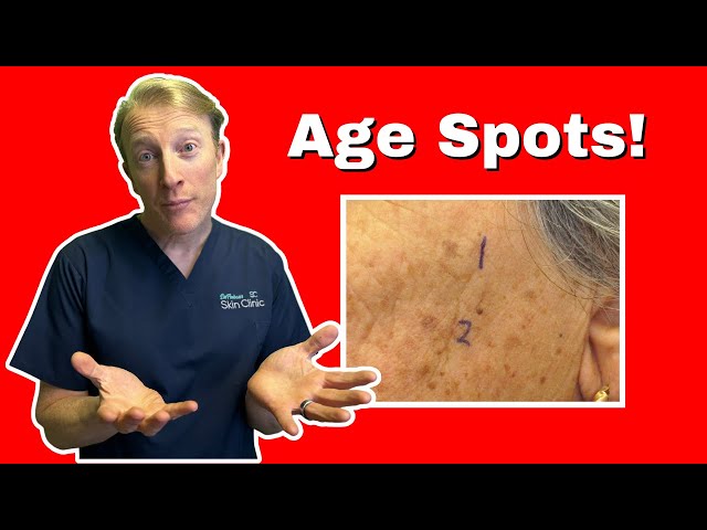 Age Spots: Getting Rid of Solar Lentigo