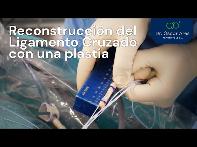 Reconstrucción del Ligamento Cruzado con una plastia - Dr. Oscar Ares