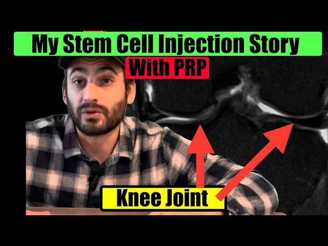 What To Expect When Getting Stem Cell And PRP Injections For Only $500! How To Repair Your Knee