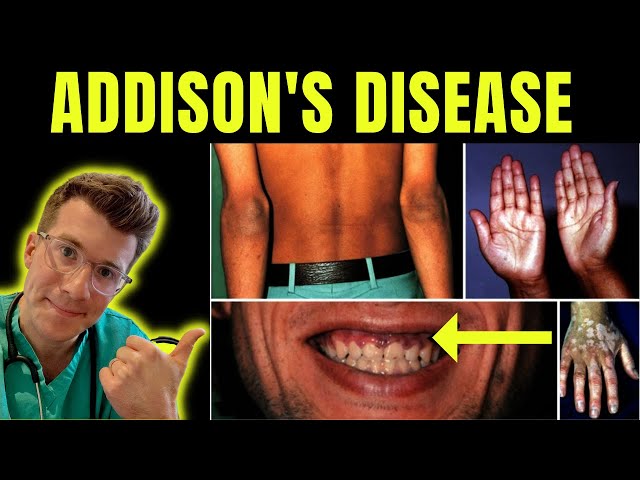 Doctor explains Addison's disease (Adrenal insufficiency): definition, symptoms, treatment & more.