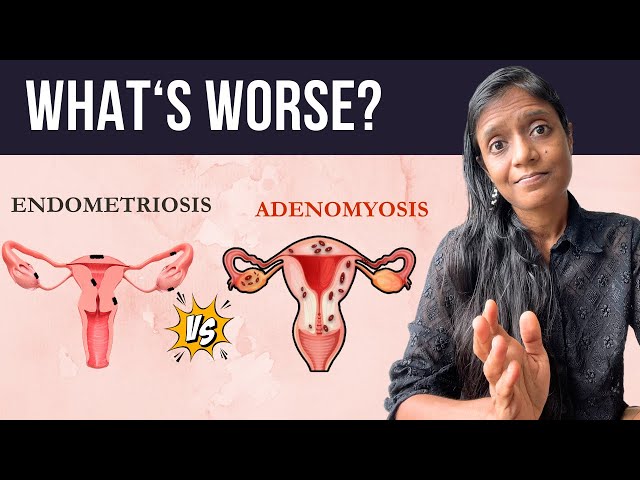 Adenomyosis Vs Endometriosis: What's the Difference?