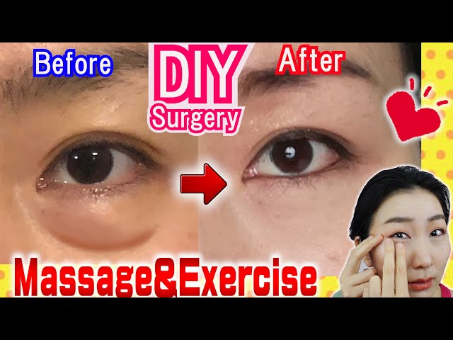 How to Remove Under Eye Bags👁️ Naturally in 7 Days Massage & Exercises🙋