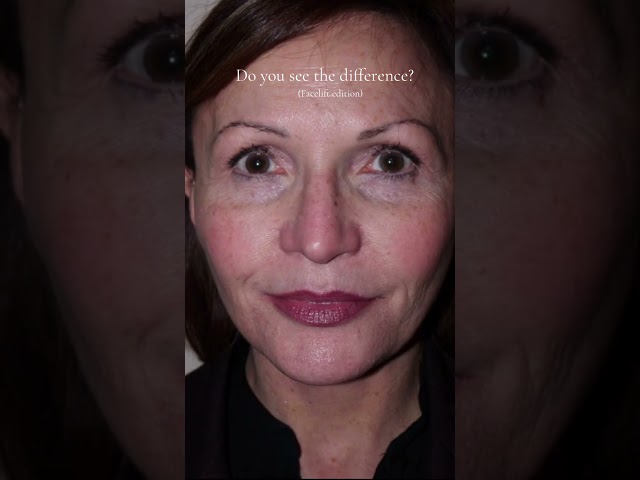 Do you see the difference ? #facelift | Schedule a Consultation (480) 418-5300