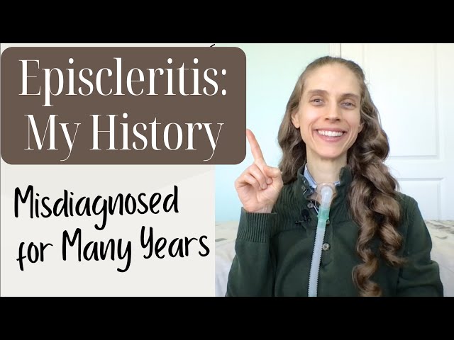 My History with Episcleritis. Pink Eye Misdiagnosis, Contact Lenses & Connective Tissue Disease