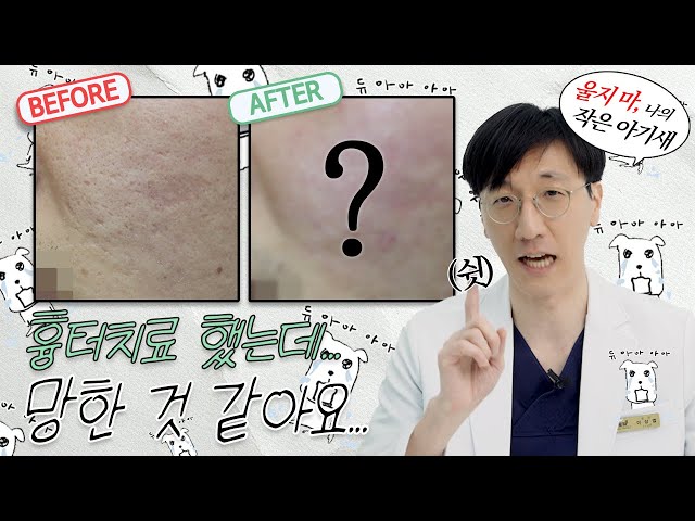 프락셀 레이저로 해결 못 한 여드름 흉터, 붉은기까지 치료한 방법 공개! #프락셀레이저 #새살침 #여드름붉은기