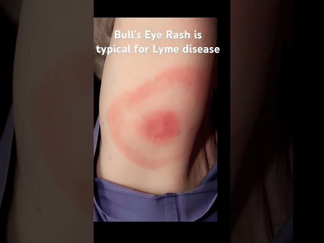 Bull”s Eye Rush is typical for Lyme Disease.