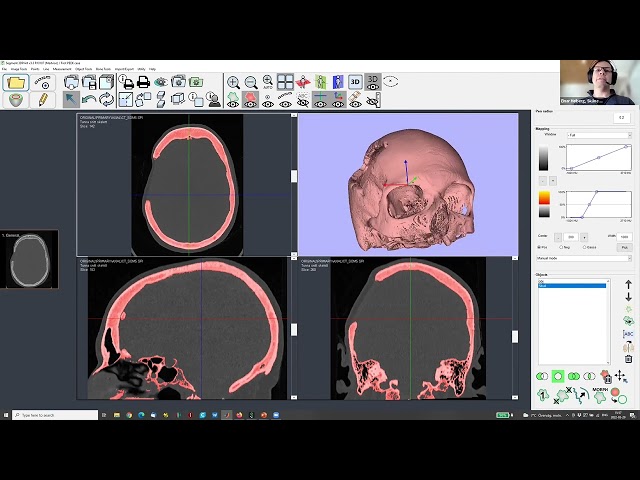 In-house manufactured PEEK cranioplasty implants – initial experience from Skåne University Hospital