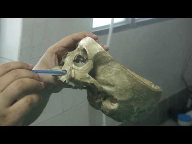 Maxillectomy- Bone cuts and Classification- Surgical Videos- Dr Rajnish Talwar