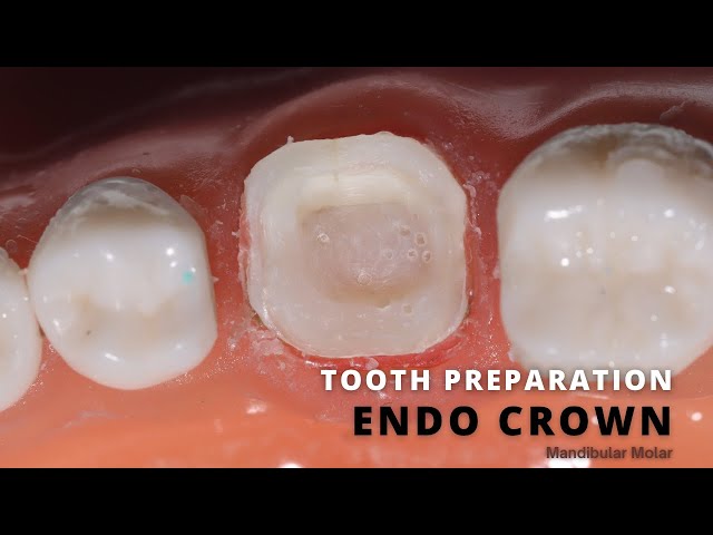 Tooth Preparation for Endo Crown 🟡 Step by Step Demonstration