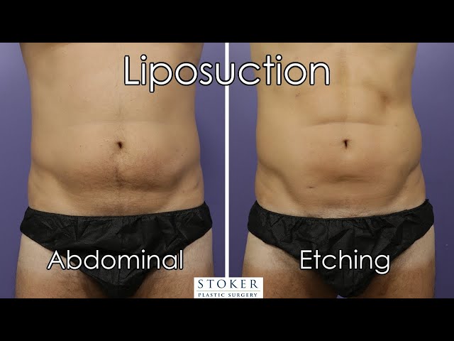 Liposuction Los Angeles: Top Plastic Surgeon Dr. David Stoker Discusses Male Liposuction & Etching