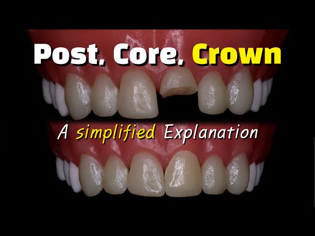 Fixing a broken front tooth with a post, core buildup and crown (after a root canal..)