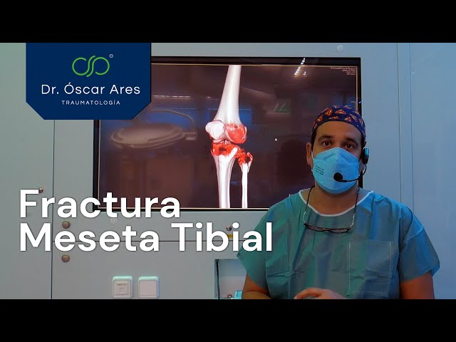 Fractura de la meseta tibial - Dr. Oscar Ares