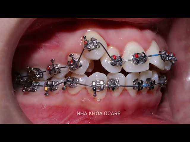 Braces process in 2 years