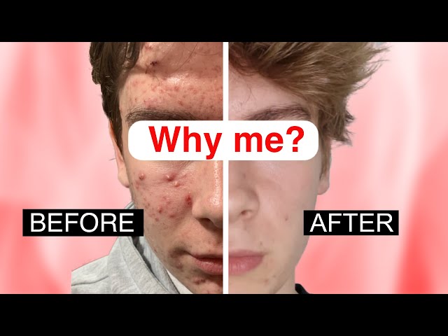 Understanding Teenage Acne & Top Tips to get rid of it!