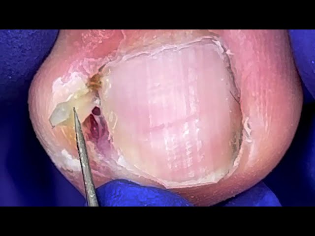 Ingrown nails grow ingrown like crazy, hiding big hooks【Doctor Liu Pedicure】