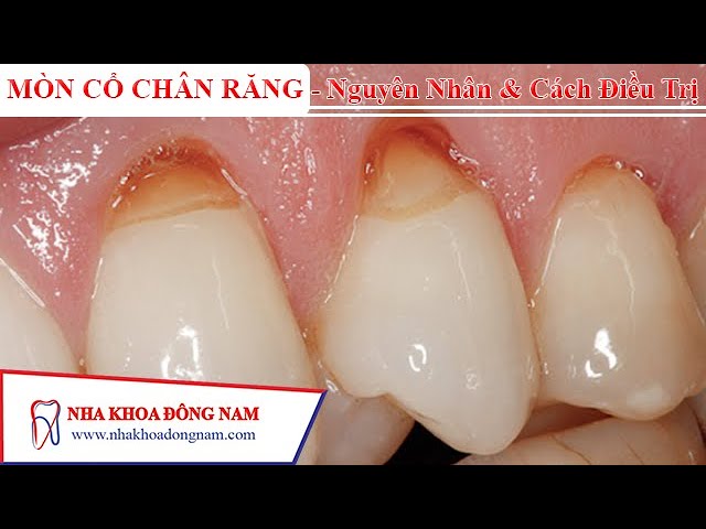 #5 MÒN CỔ CHÂN RĂNG - Nguyên Nhân & Cách Điều Trị | NHA KHOA ĐÔNG NAM®