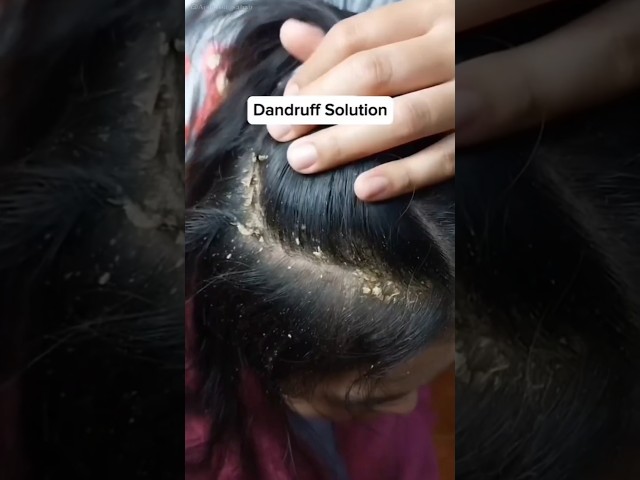 Remove Dandruff Naturally | Best Solution For Dandruff | #shorts #haircare #virelshorts