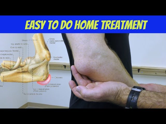 Elbow Bursitis Treatment at Home - How to Treat Olecranon Bursitis