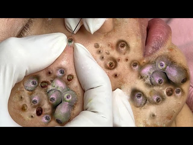 Achieve Inner Peace with Botfly Removal and These Facial Cleansing Methods ASMR #047