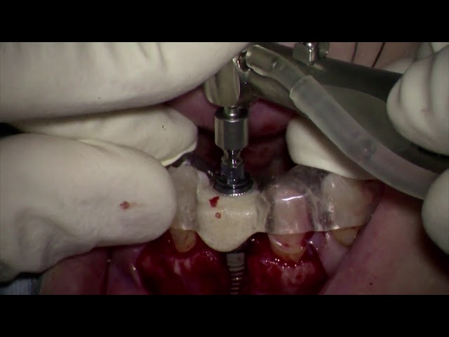 Straumann Roxolid implant placement in anterior maxilla