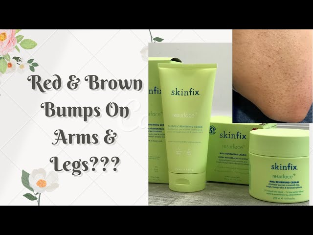 Keratosis Pilaris - Causes & Cure | Skinfix Resurface Review