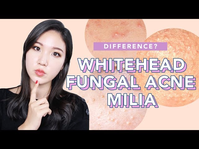 🤔Difference Between Whiteheads, Milia and Fungal Acne : What it is, How to treat