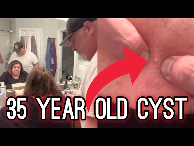 35 YEAR OLD Cyst | Satisfying HARD POP and BLACKHEAD Removal | #TheBubbaArmy #blackheadremoval