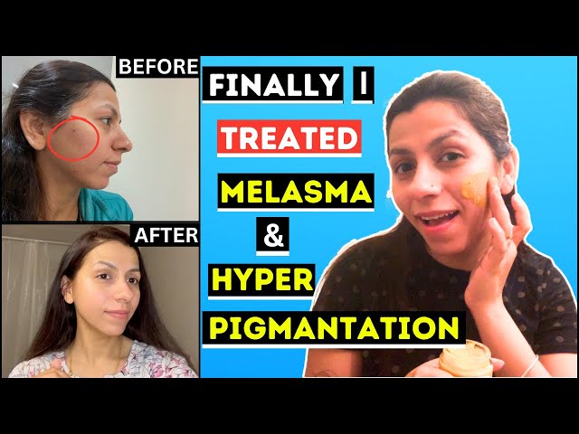 You Won’t Believe How I Treated My Hyperpigmentation at Home Shocking Before & After! Dr Madiha