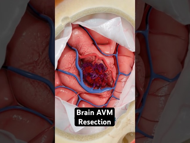 AVM: Bleeding in your brain (3D Animation)