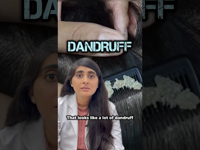 Dandruff | How to treat dandruff | Best treatment for Dandruff