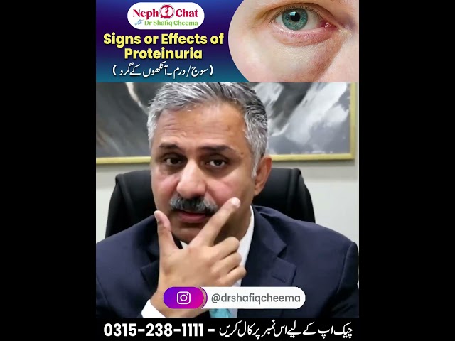 Periorbital edema or Eye Swelling #shorts #edema #proteinuria