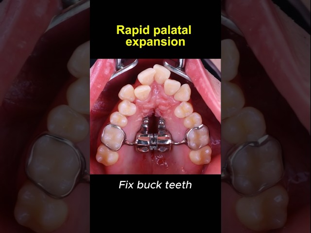 Expand upper teeth with rapid palatal expander #braces #orthodontist #dentist