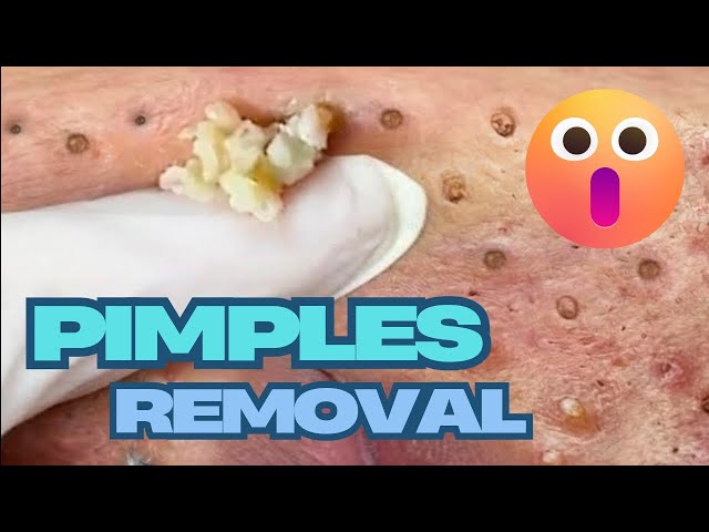 pimples removal compilation 😧 pimples popping #pimple #pimplepopping #pimples #asmr