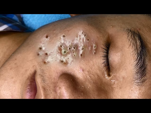 Big Cystic Acne Blackheads Extraction Blackheads & Milia, Whiteheads Removal Pimple Popping #088