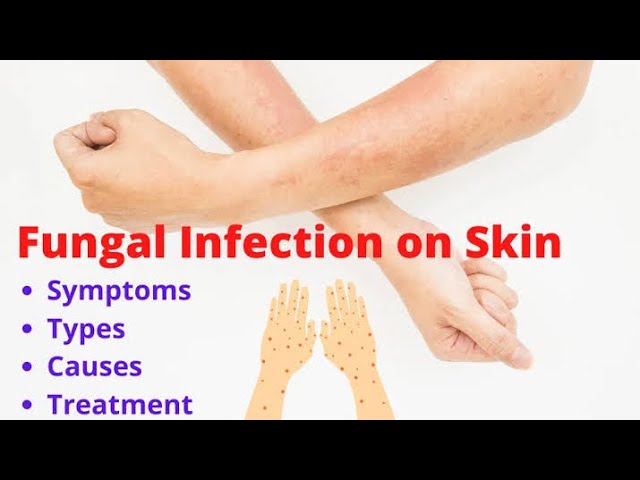 Reson for fungal infection