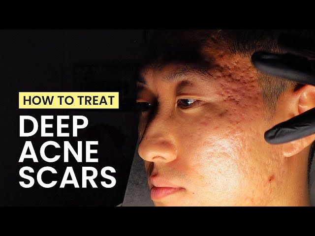 How to Treat Deep Acne Scars: TCA Cross, Subcision, CO2 Laser, Bellafill