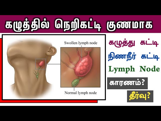 கழுத்தில் நெறிகட்டுதல் குணமாக | நிணநீர் கட்டி | lymph nodes in the neck treatment | Next Day 360