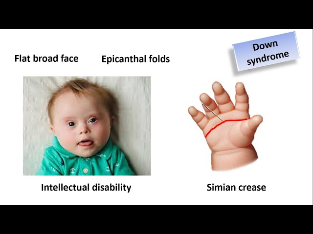 Birth defects: Chromosomal  abnormalities in Bangla | Monosomy | Trisomy | Translocation | Mosaicism