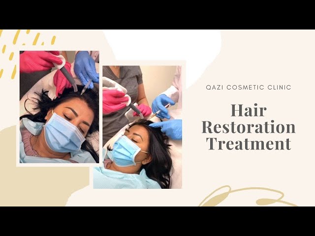 Hair Restoration using PRP Injections |  Live with Dr. Nadir Qazi