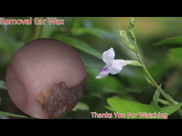 Removal of Ear Wax from Entier Ear Canal