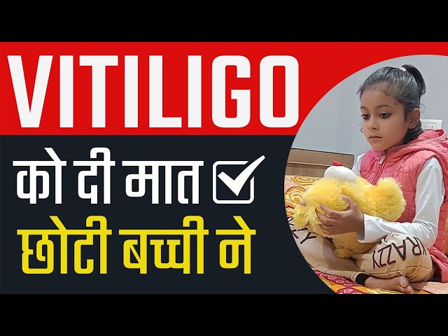 सफ़ेद दाग से कैसे मिला छुटकारा? | Vitiligo Patient Recovery | Dr. Megha Chaturvedi