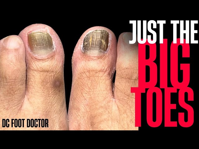 Just The Big Toes: Trimming Fungal Toenails