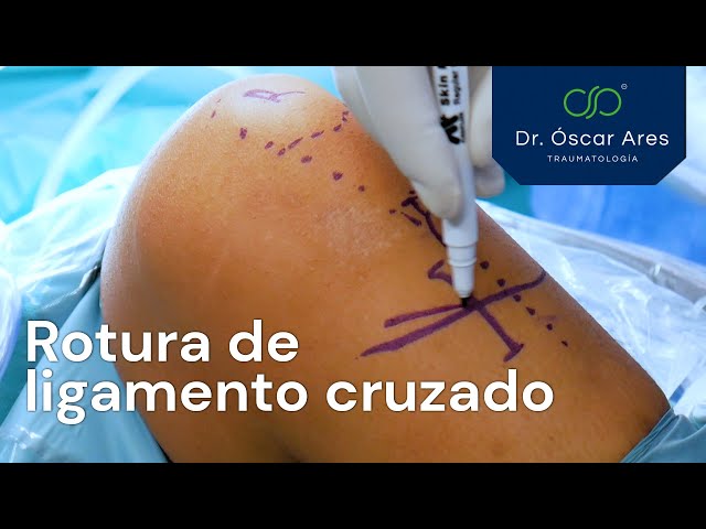 Rotura de ligamento cruzado y Sutura Meniscal - Dr. Oscar Ares