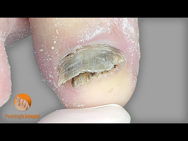 Fungal nails | Podología Integral