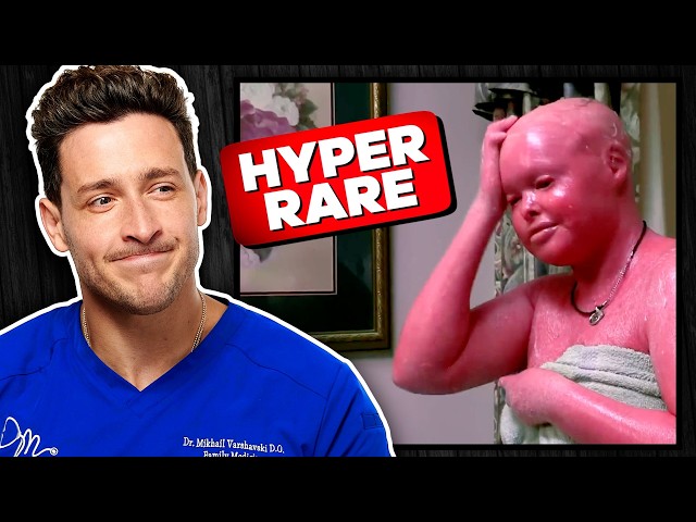 Doctor Reacts To Rarest Diseases