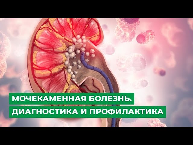 Мочекаменная болезнь. Диагностика и профилактика.